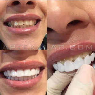 Snap-On Smile в аптеке